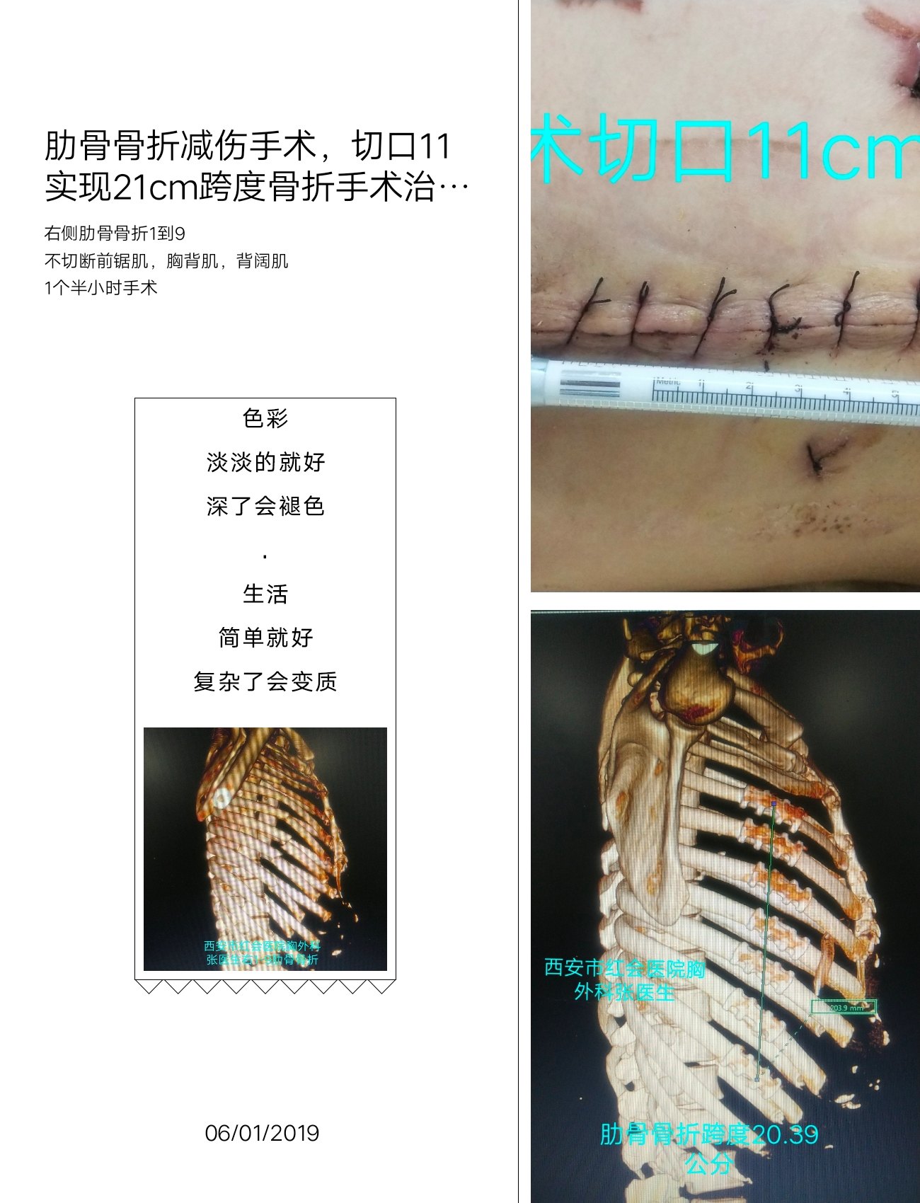 肋骨骨折手术没有对比就没有伤害 肋骨骨折手术没有对比就没有伤害