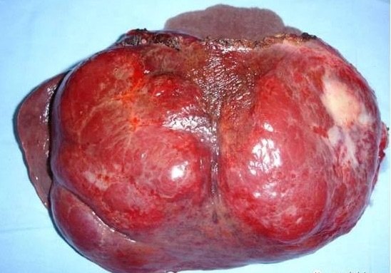 肝右叶血管瘤图片