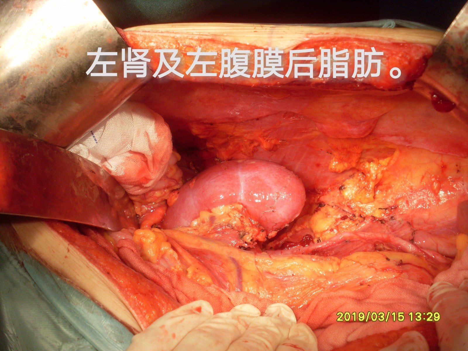 病例(26)--左側腹膜後巨大腫瘤切除 - 好大夫在線