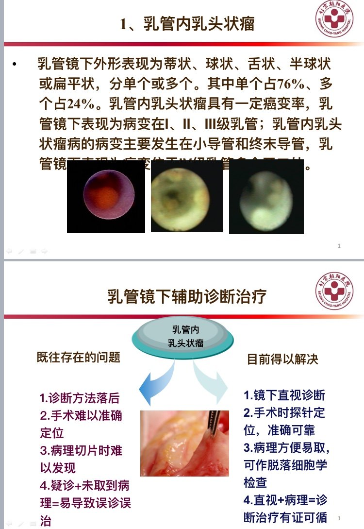 乳管内肿瘤的诊治 乳腺导管内乳头状瘤 好大夫在线