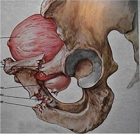 ⑤ 车祸等严重外伤导致骨盆骨折:常会导致尿道膜部断裂,后者发展为后