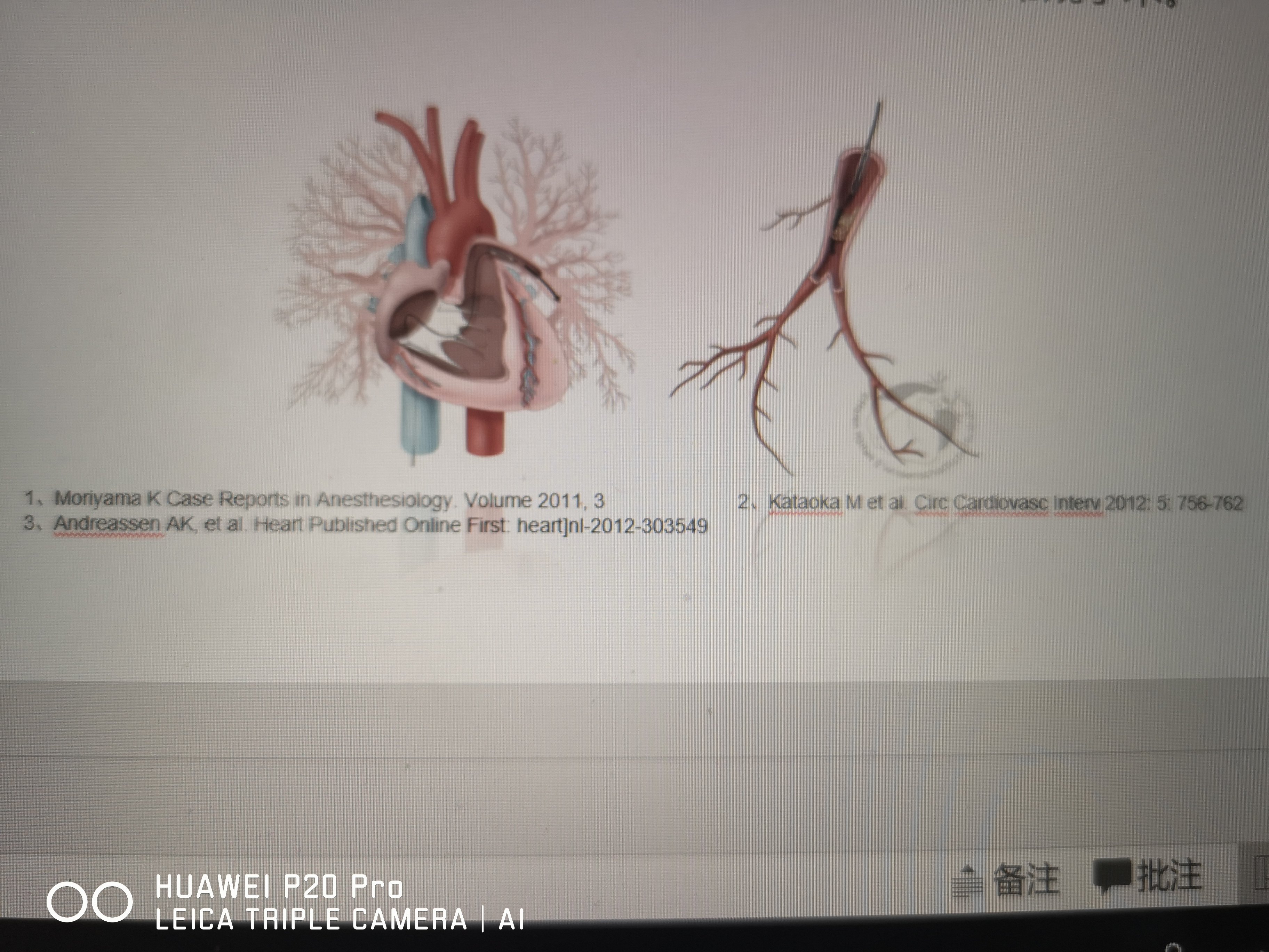 肺动脉瓣关闭不全_肺动脉关闭不全_肺动脉关闭不全杂音