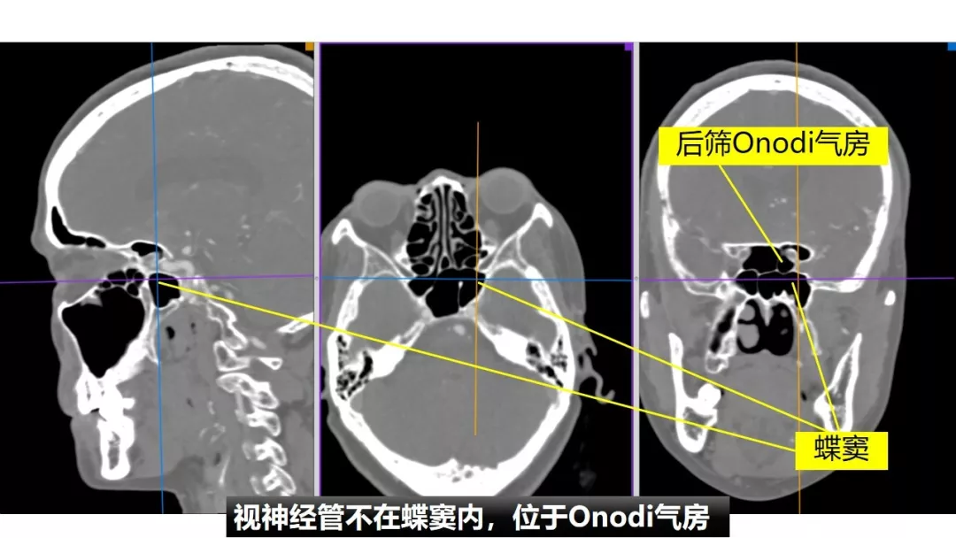 前床突磨除與腦積液漏處理-中鼻道經篩入路解剖,閱片與手術 - 好大夫