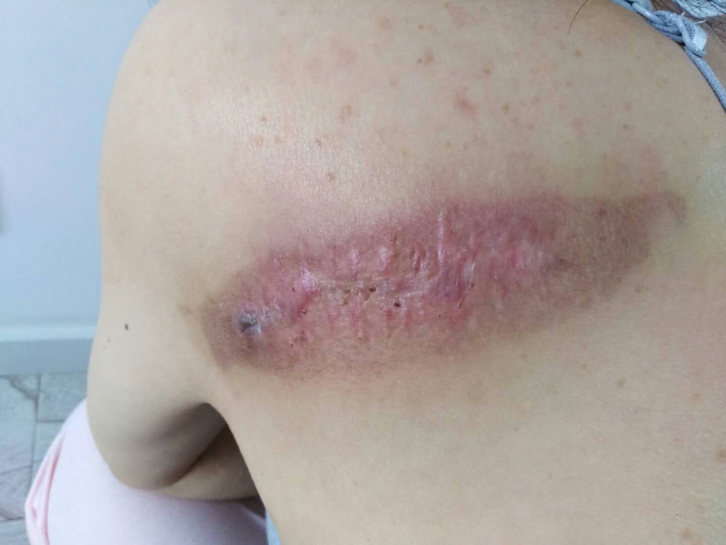 放疗一个月后背部瘙痒,偶尔疼痛,局部高起皮肤表面该图片可能引起不适
