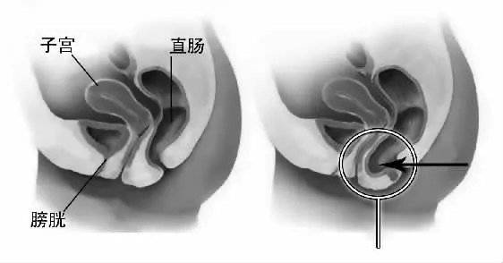 直腸前突的診斷和治療_直腸肛管疾病_疾病介紹_檢查_治療方法_相關