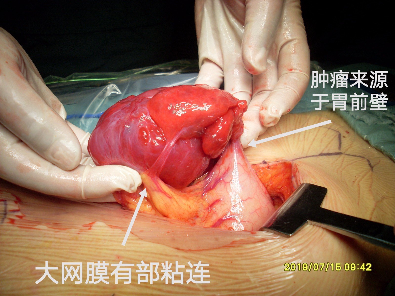 病例97--腹水并右上腹肿物,cea,ca199正常考虑间质瘤