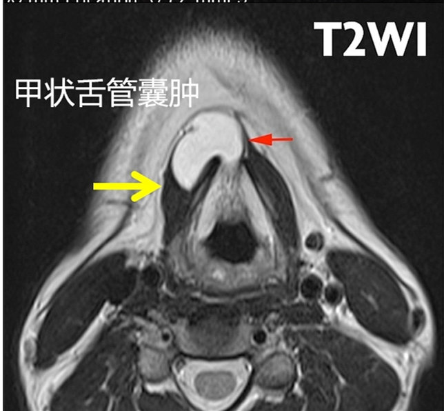 甲状舌管囊肿图片图片