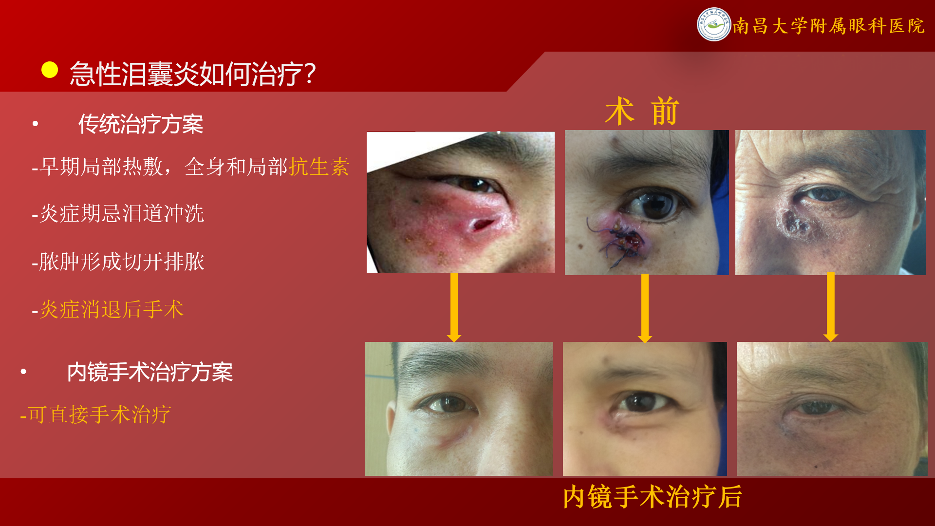 “泪囊炎”如何治疗? - 好大夫在线