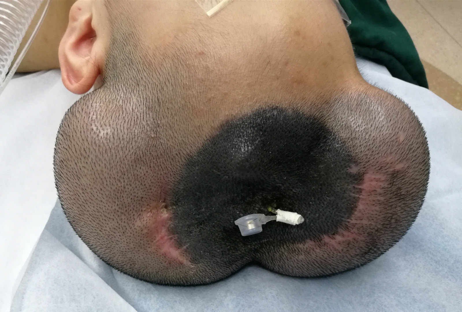 先天性巨痣有哪些表现应该采取什么措施治疗