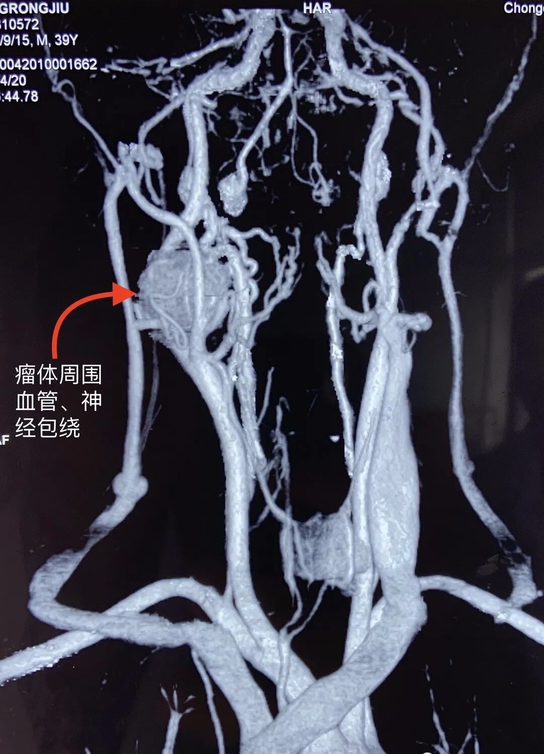 颈动脉斑块药物治疗疗程_颈部药物动脉治疗斑块效果好吗_颈部动脉斑块治疗药物