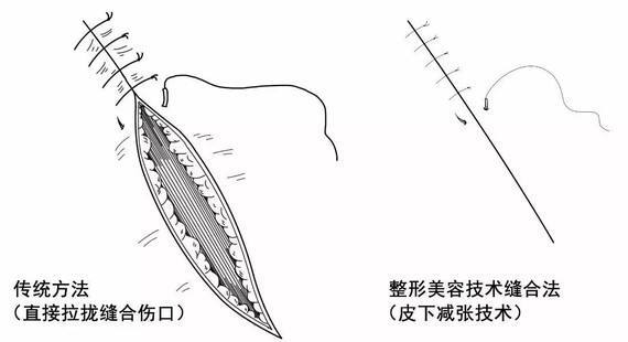 1,减张缝合 通常缝合尽量美容缝合(包括减张缝合以及应用美容线或者尽