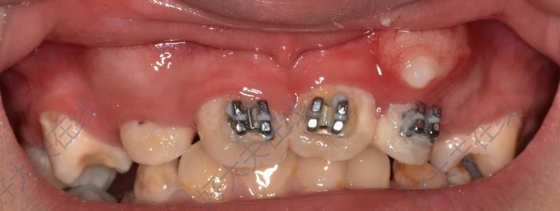 上颌中切牙埋伏阻生_阻生齿 - 好大夫在线