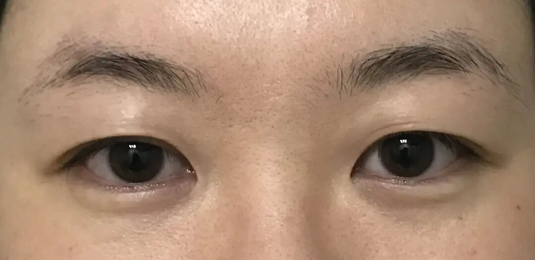 都可以通过重睑术去除多余松弛的皮肤形成新的双眼皮