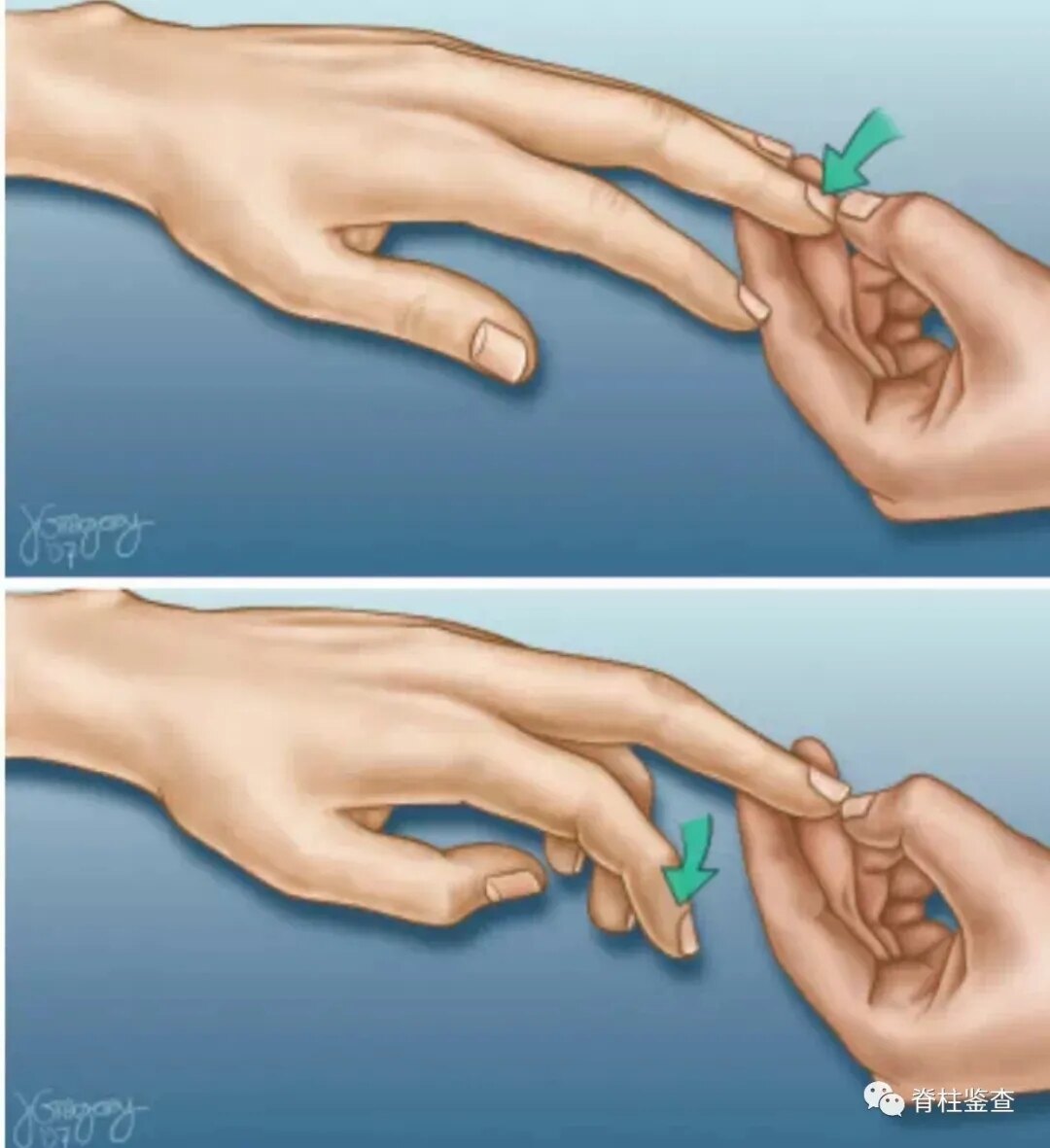 影像资料四肢麻木无力脚踩棉花感,hoffmann征阳性患者情况03脊髓型