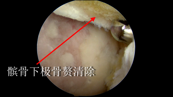 x髌骨下极骨赘清除.png