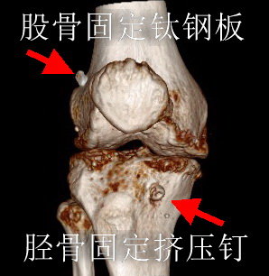 Right Hip Joint CT 3D.-VRT Range-.Se602.Img3.jpg