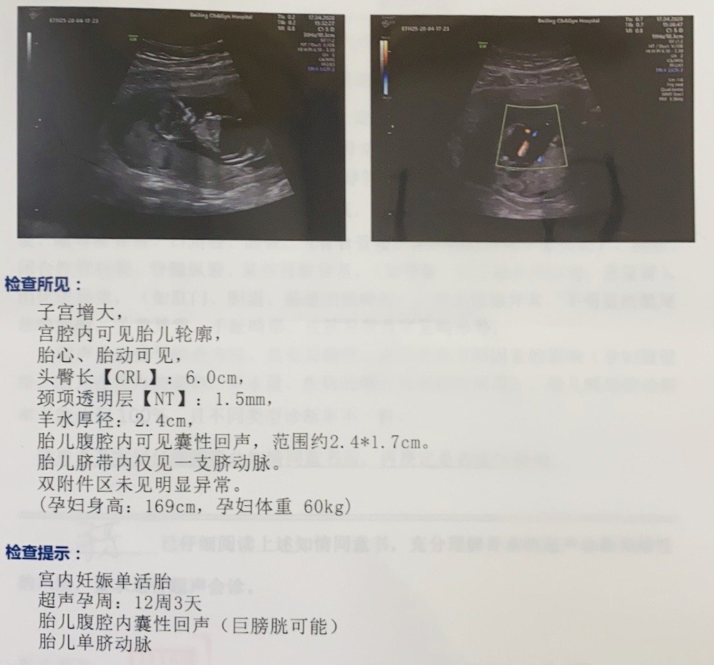 胎儿巨膀胱不只是膀胱大而已 产前检查 产前检查