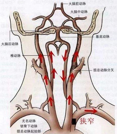 左锁骨下动脉闭塞图片