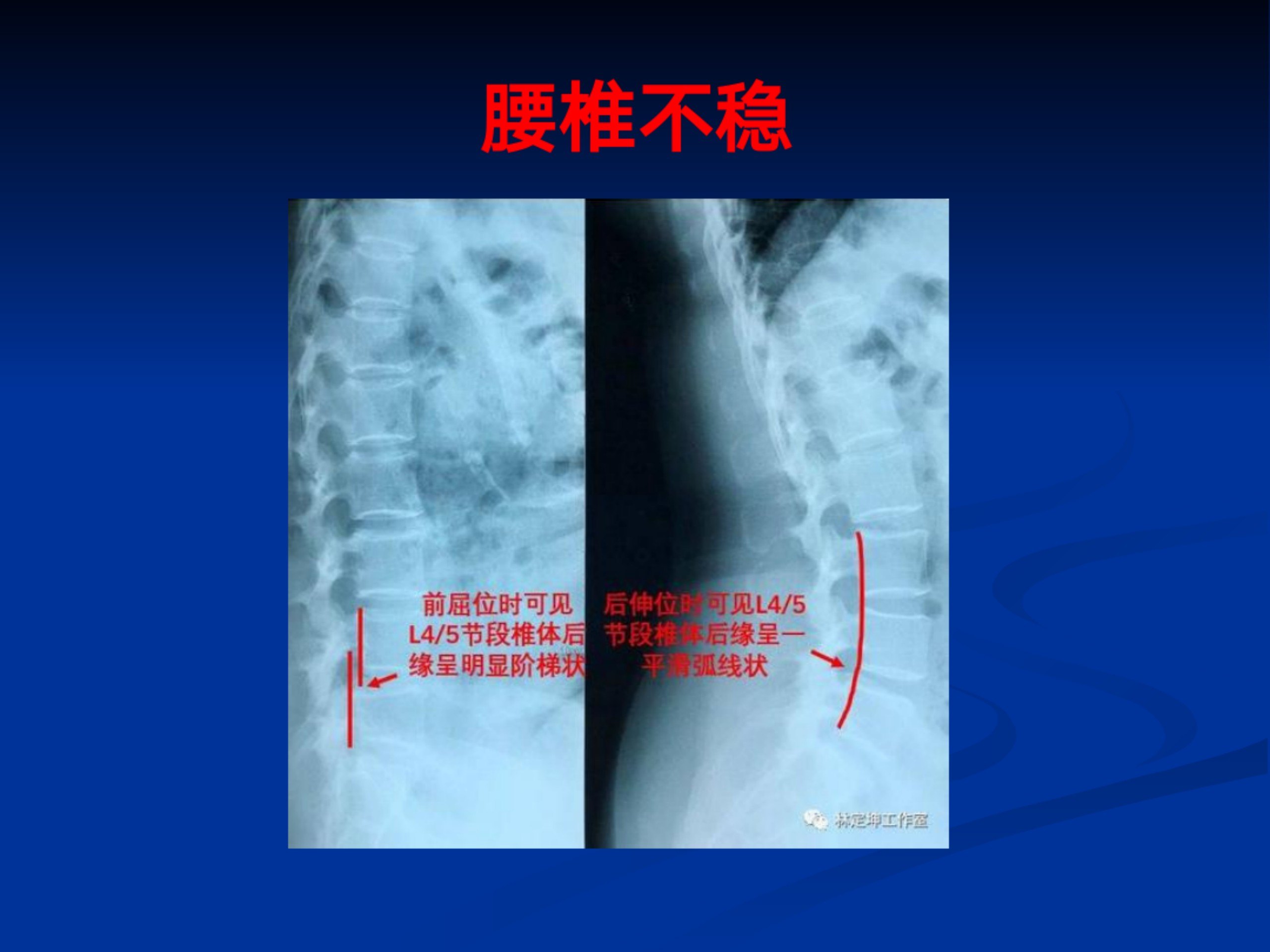 浅谈腰痛(1)_35.jpg