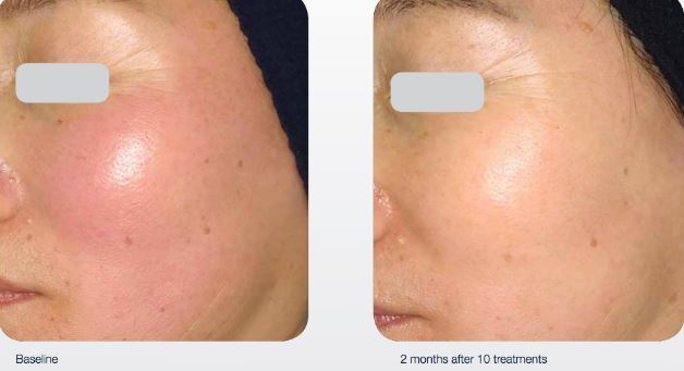 光子嫩肤(强脉冲光, ipl)_激光美容_激光美容治疗介绍 - 好大夫在线