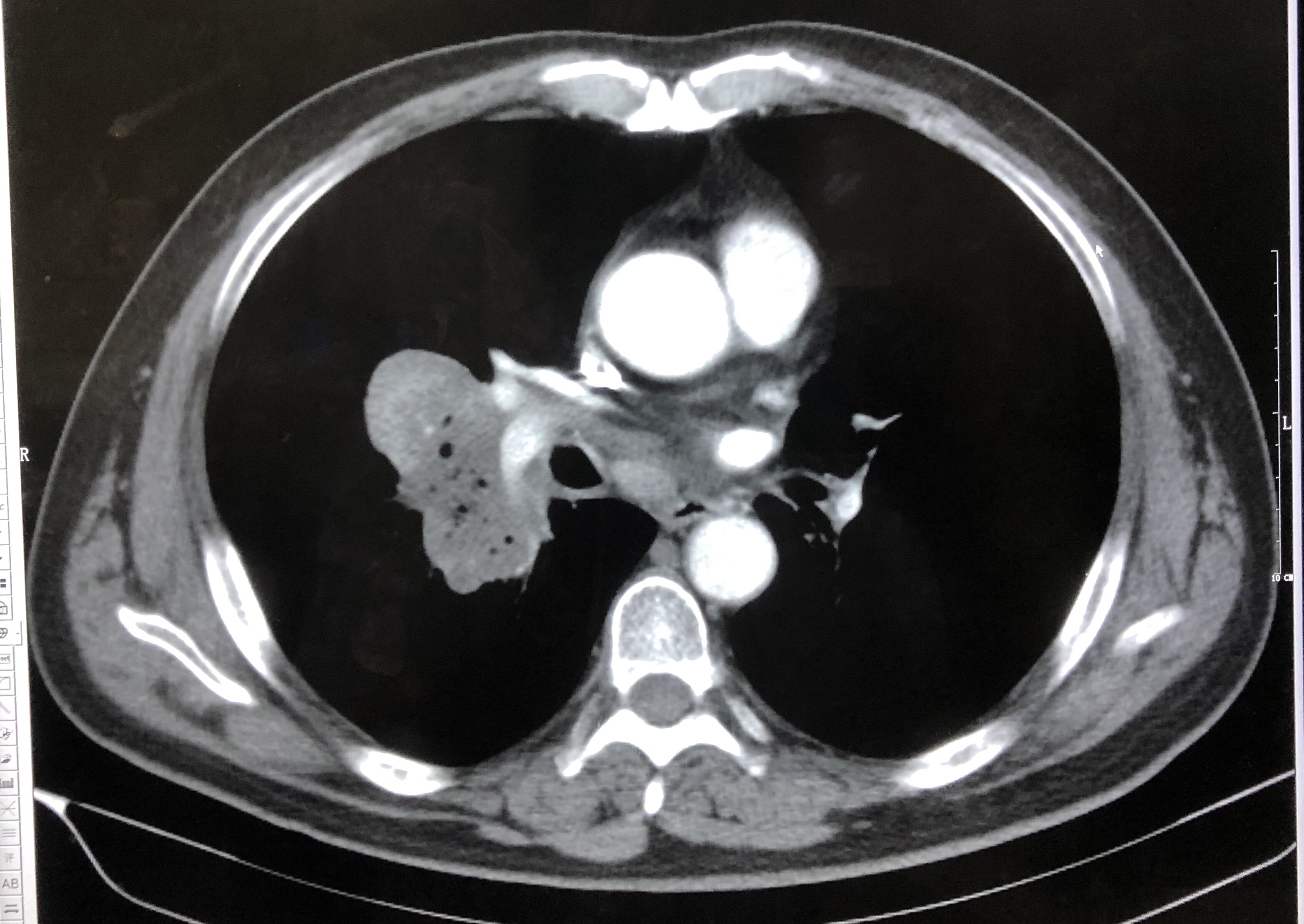 中央型肺癌ct影像图片图片