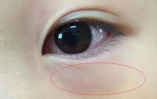 微信小孩黑眼圈图片图片