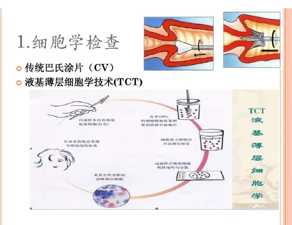 宮頸細胞學檢查是怎麼回事