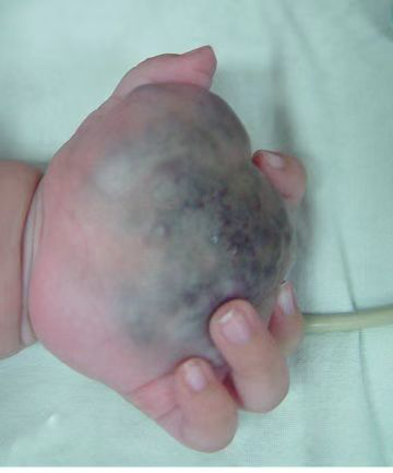 硬化剂治疗儿童血管畸形_血管瘤_血管瘤治疗方式 - 好大夫在线