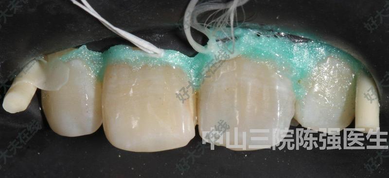 变色死髓牙漂白治疗