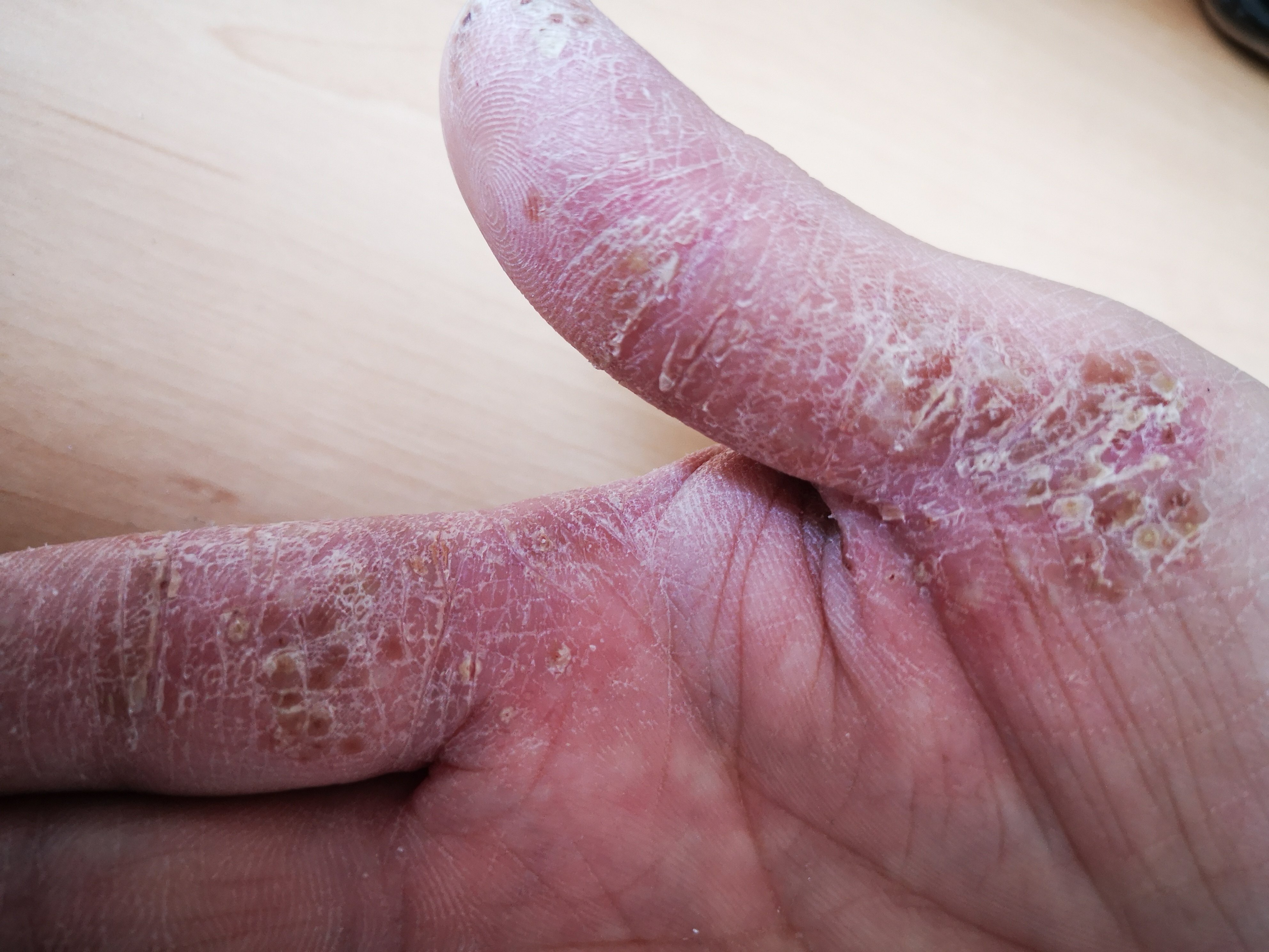 皮损的发生机制浅析 - 好大夫在线