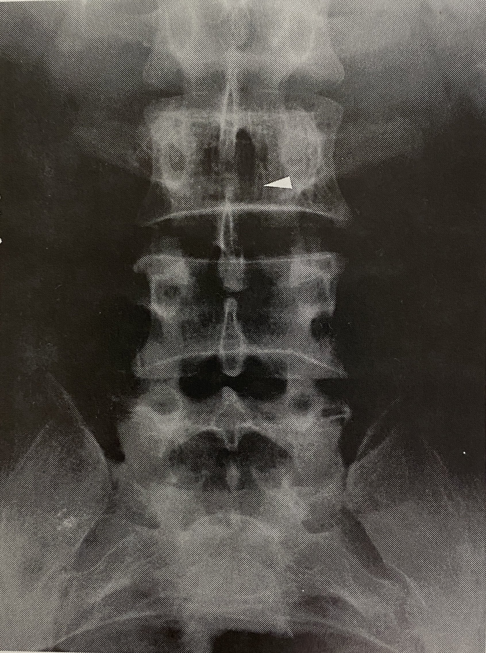 骨血管瘤_血管瘤_血管瘤介绍 - 好大夫在线