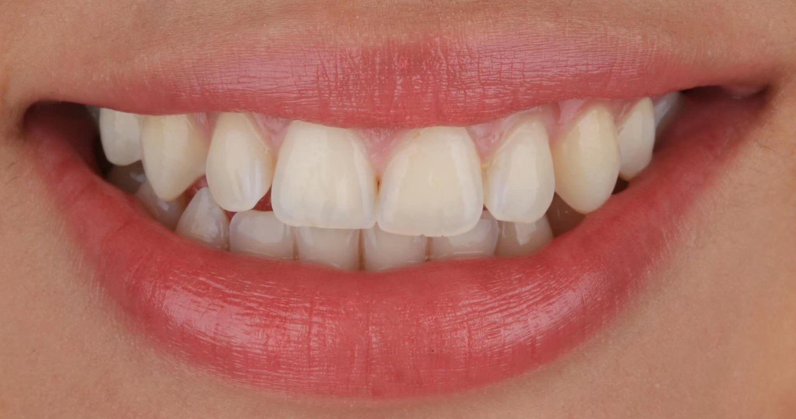 前牙美学修复关闭缝隙一例_牙颌畸形_牙颌畸形治疗方式 - 好大夫在线