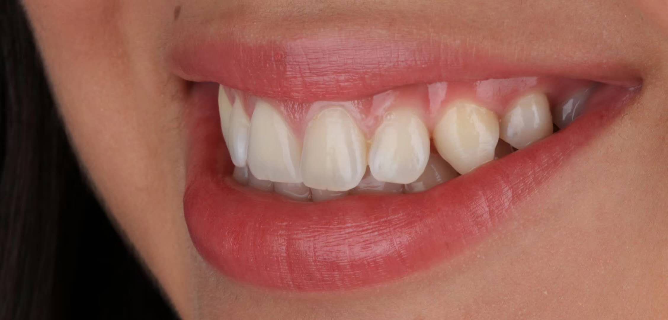 前牙美学修复关闭缝隙一例_牙颌畸形_牙颌畸形治疗方式 - 好大夫在线