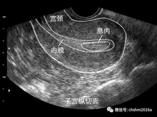 宫腔线变形图片