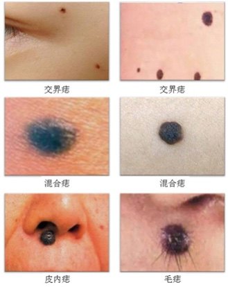 根据黑色素细胞巢在皮肤组织层次上的分布分类交界痣:病灶分布于表皮