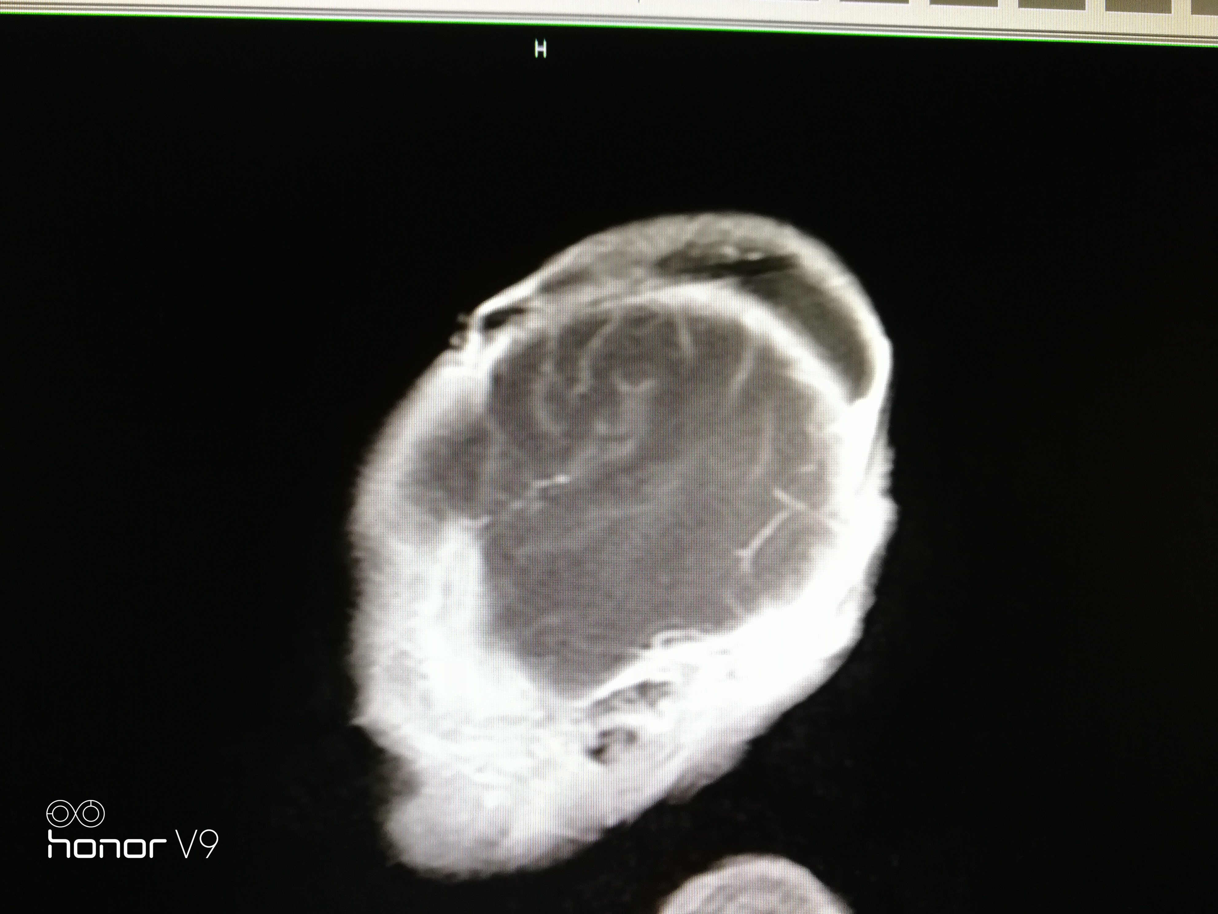 帽状腱膜下血肿ct表现图片