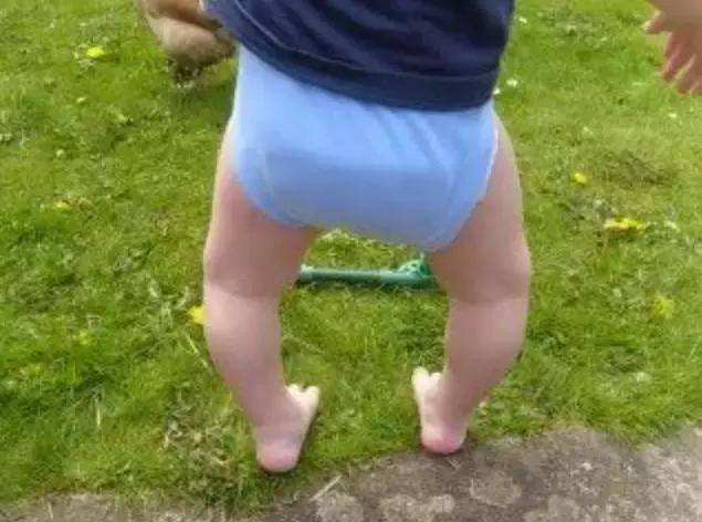 o型腿不可怕,姚大夫教你如何后天矫正?