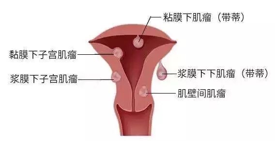 孕妇怀孕宫颈图图片