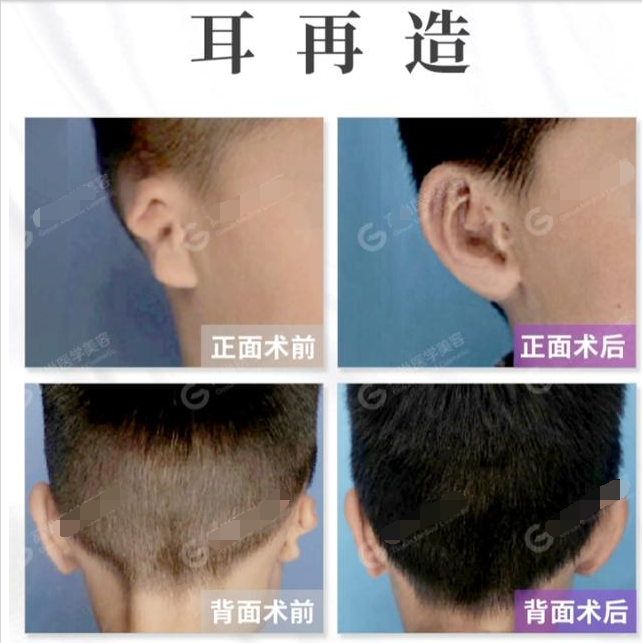 耳再造手术后的再造的耳朵会变形吗 耳再造 治疗介绍 护理及注意事项 好大夫在线 耳再造手术后的再造的耳朵会变形吗 耳再造 治疗介绍 护理及注意事项 好大夫在线