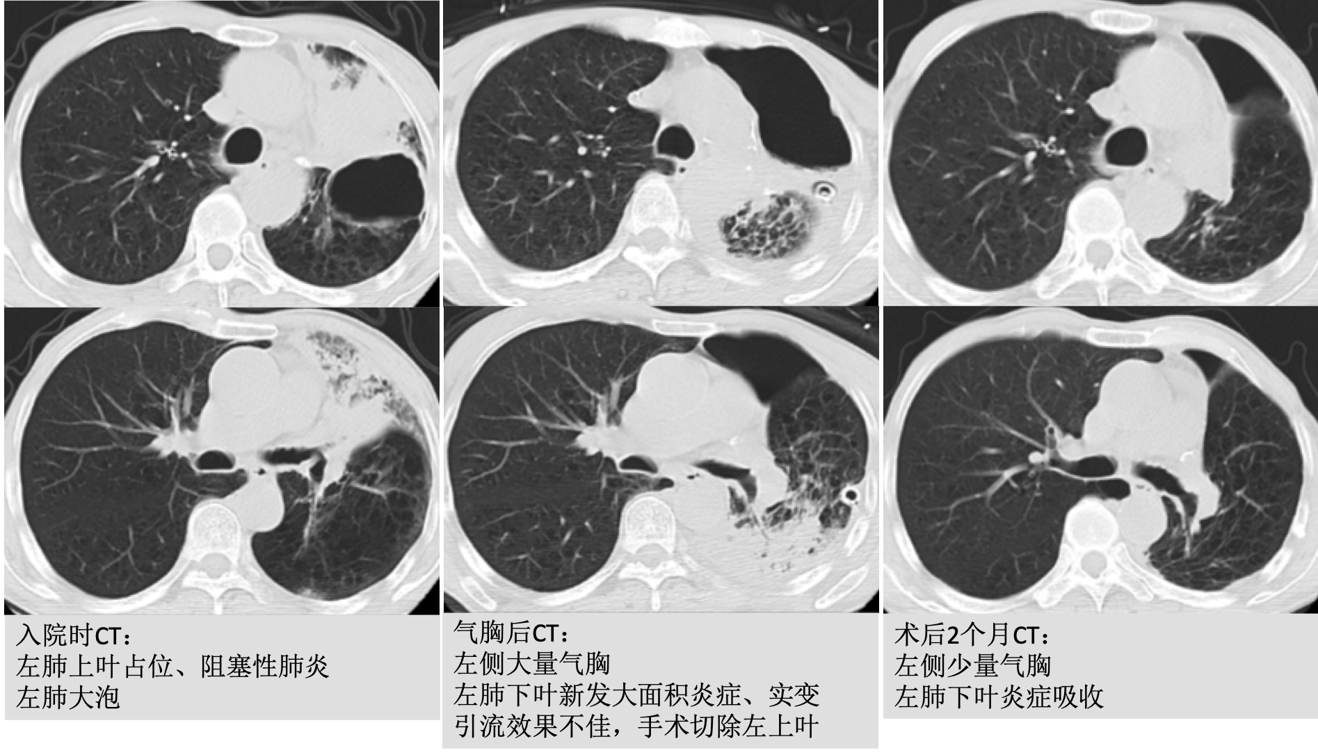 点评1,这是一例肺癌继发肺大泡,肺大泡破裂引起气胸的患者,由于患者