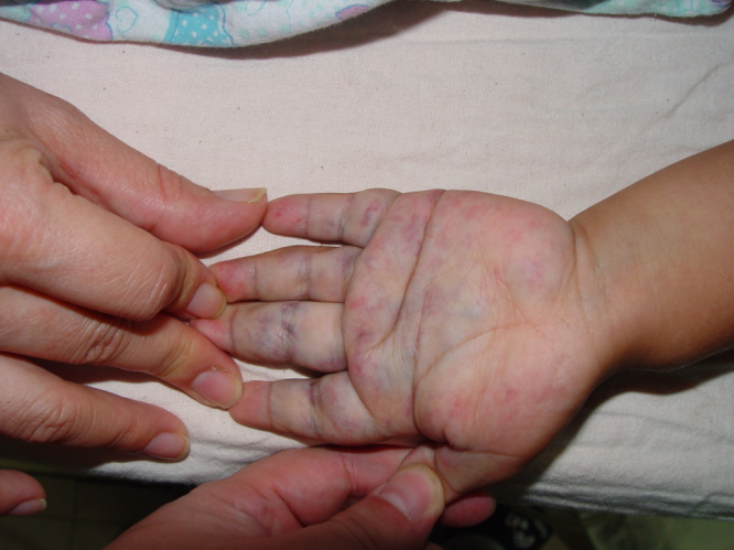 手掌血管瘤的症状图片图片