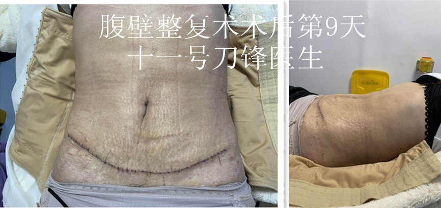 腹部整形手术前后图片图片