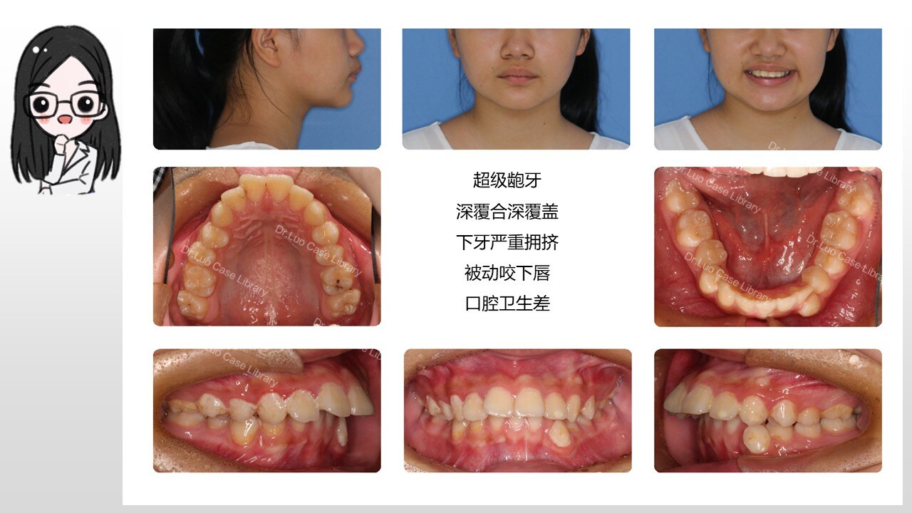 青少年拔牙矫正突面型