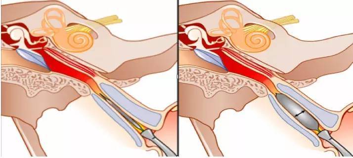 咽鼓管功能障碍的诊断和治疗——转自上海新华医院听力中心