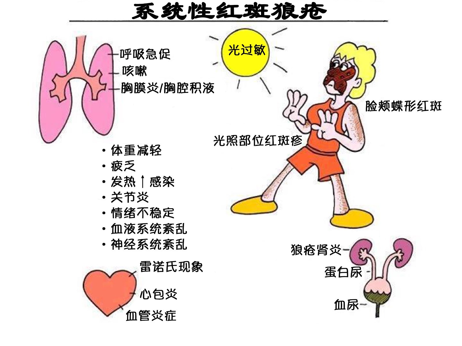 系统性红斑狼疮是一种病因未明,自身免疫介导的,炎症性结缔组织病.