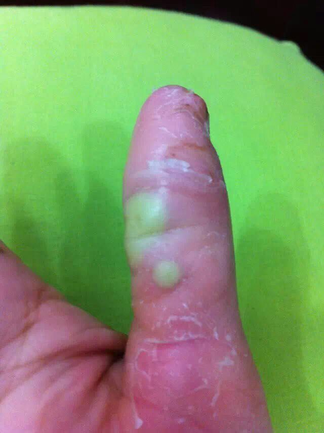 手指长疔疮症状图片图片