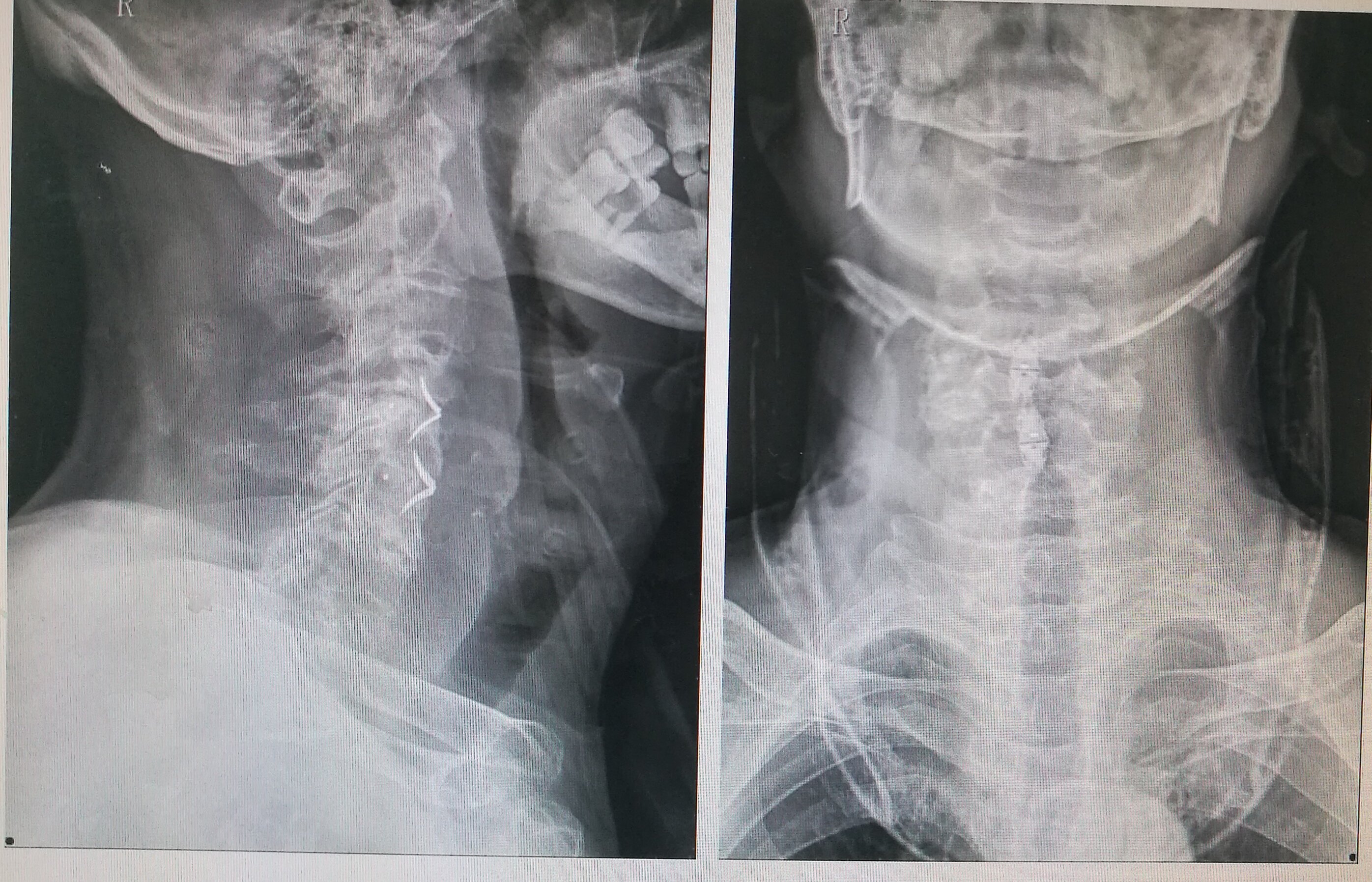 颈椎椎体滑脱图片