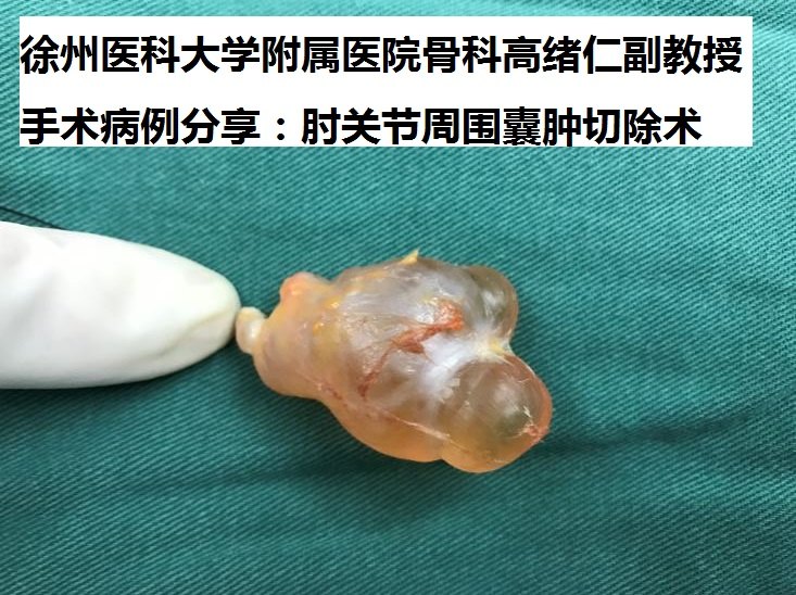 徐州二院骨科专家高绪仁手术病例分享:肘关节周围囊肿切除术 