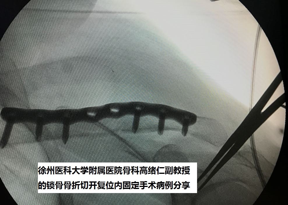 徐州二院骨科高緒仁如何切開復位鋼板內固定治療鎖骨骨折