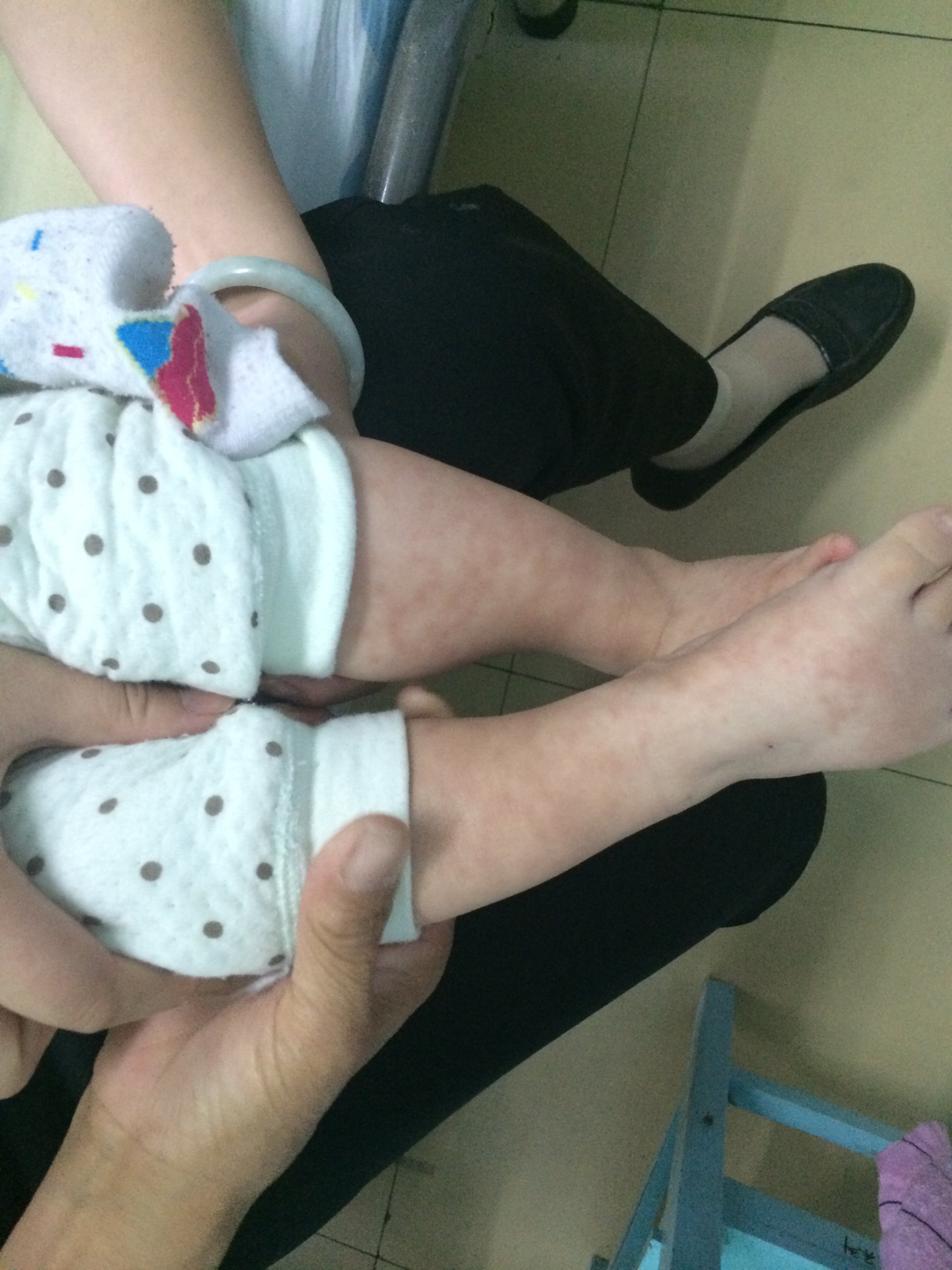 过敏性紫癜出院回家后饮食建议 - 好大夫在线